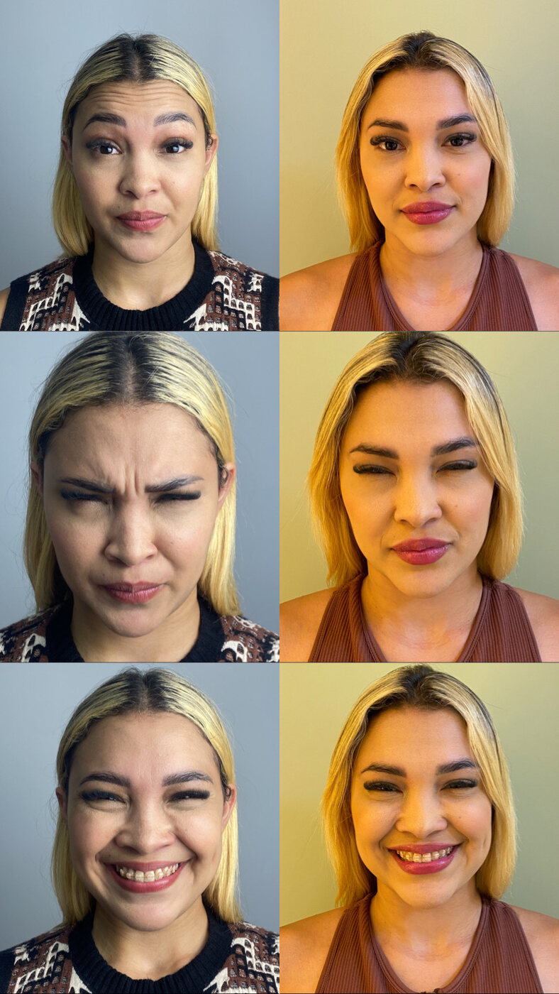 Antes e depois de toxina botulínica nas linhas de expressão (com autorização da paciente)